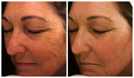 Laser for skin pigmentation, sunspots and tattoo removal