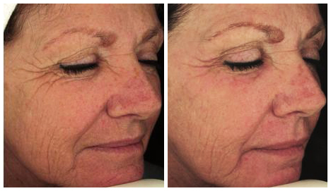 Laser for skin pigmentation, sunspots and tattoo removal