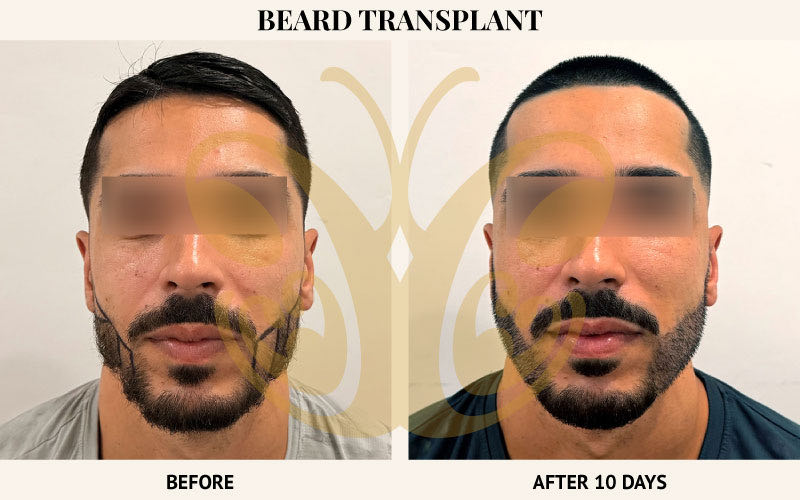 Beard transplant before and after