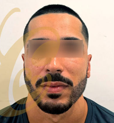 The same beard ten days after the transplant