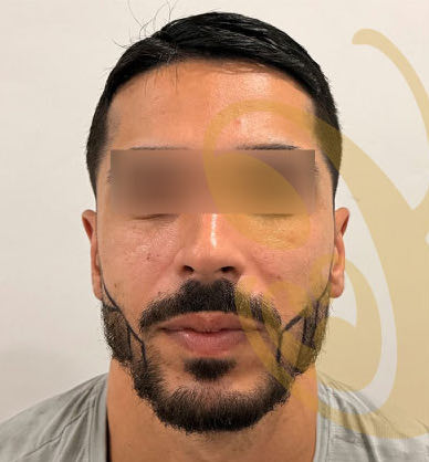 A man's beard before a beard transplant, the planned beard line drawn on his cheeks