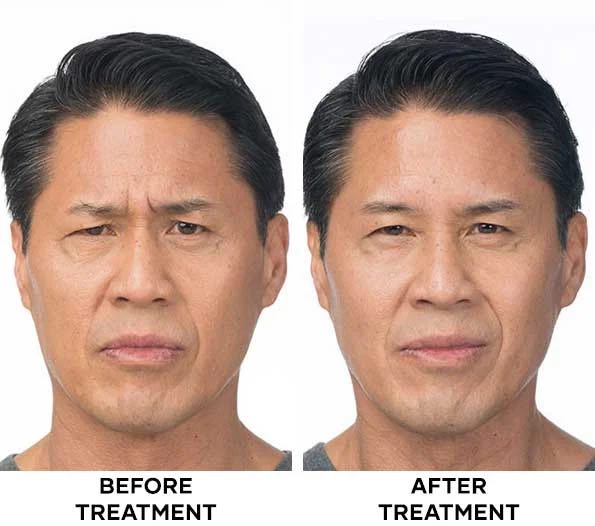Facial lines before and after treatment result