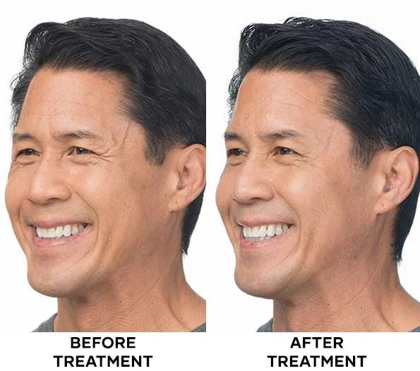 Botox before and after comparison