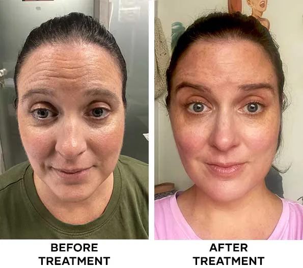 Botox treatment result example