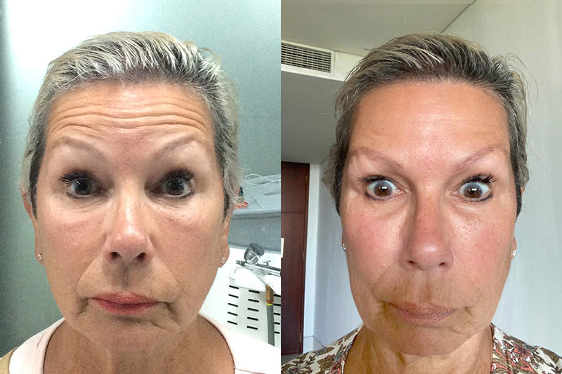 Expression lines before and after result