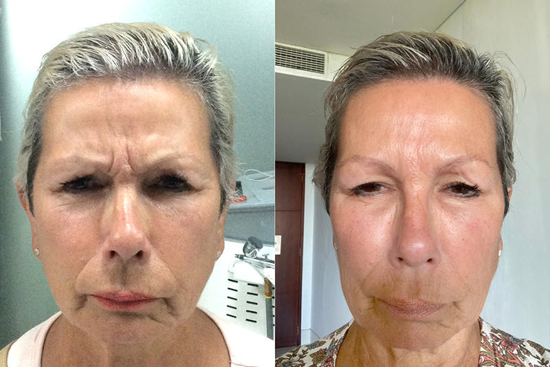 Forehead treatment before and after result