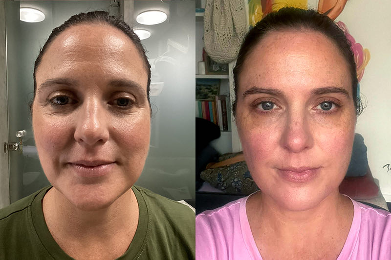 Her face at rest before Botox to the forehead, around the mouth and the jaw muscle