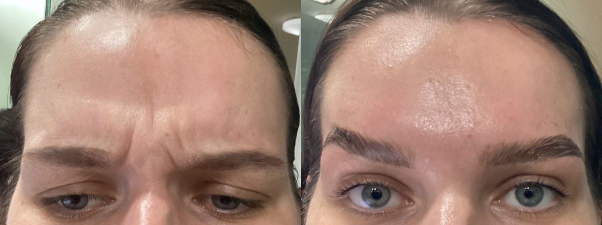 Frown lines between the brows before Botox