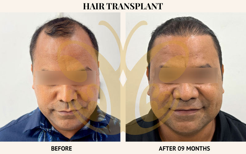 Hair transplant before and after nine months