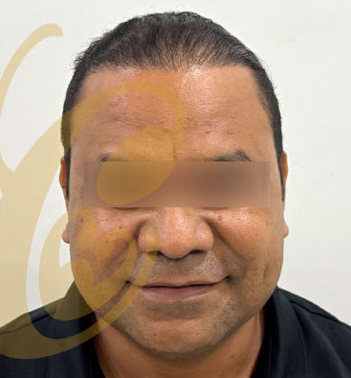 The same hairline nine months after the transplant, from the front