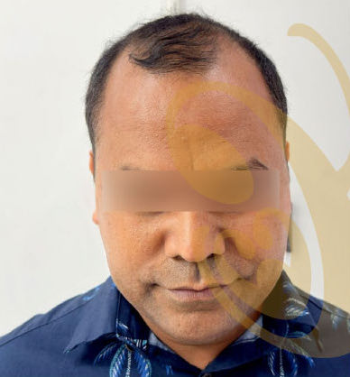 A man's thinning hairline before a hair transplant, from the front