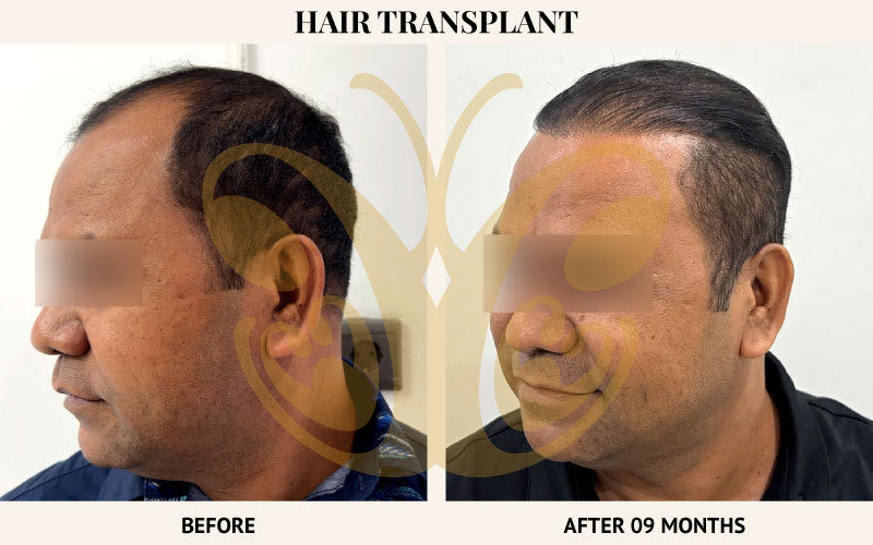 Hair transplant progress before and after