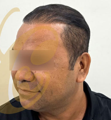 His hairline nine months after the transplant, from the side