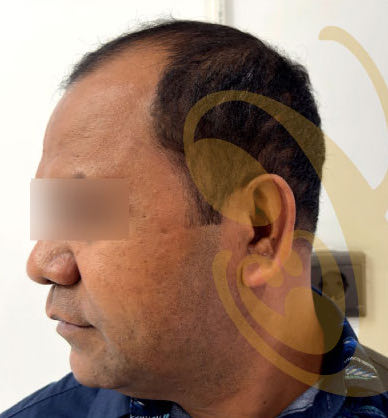 The same man's thinning hairline before the transplant, from the side