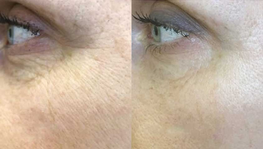 Fine lines under an eye before a peptide skin booster, in the maker’s photograph