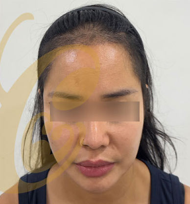 The same hairline five months after the transplant