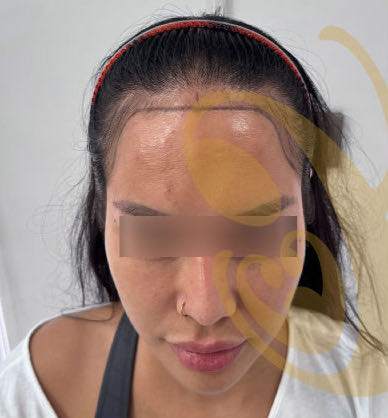 A woman's hairline from the front, before a hair transplant