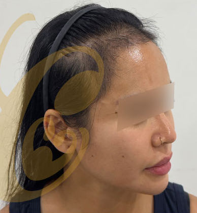 Her hairline in profile, five months after the transplant