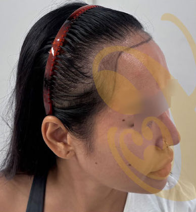The same woman's hairline in profile, before the transplant