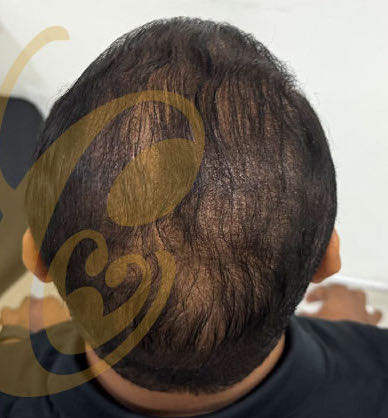The same crown from above, nine months after the transplant