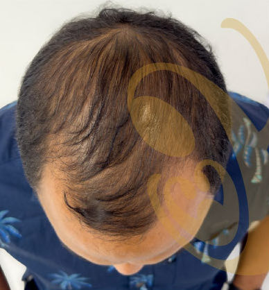 A man's thinning crown from above, before a hair transplant
