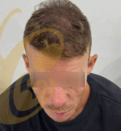 The same hairline ten months after the transplant