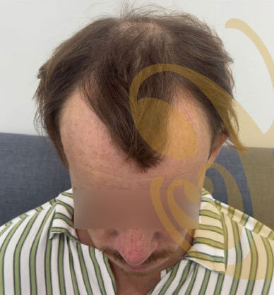 A man's receding hairline from the front, before a hair transplant