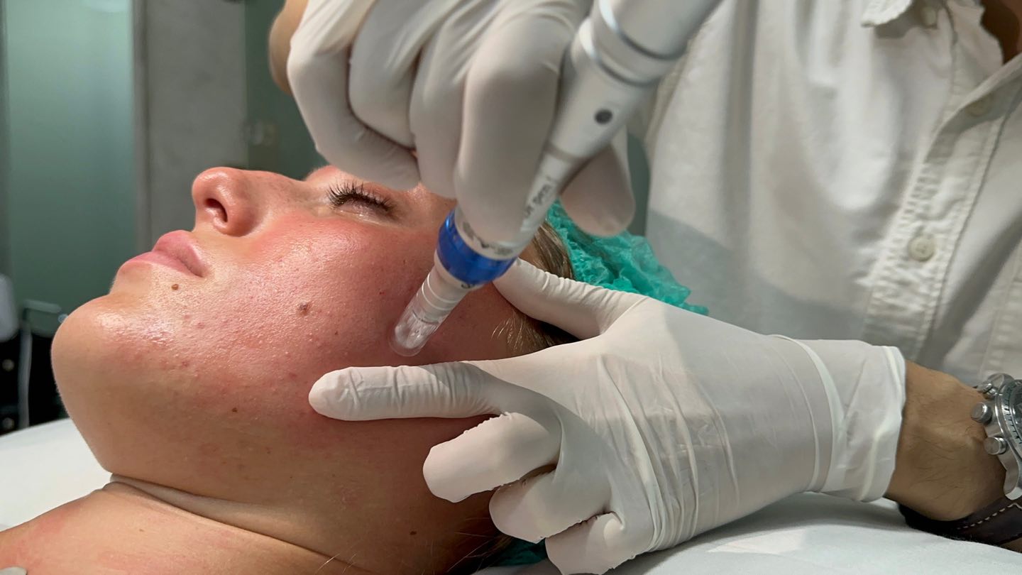 Gloved hands moving the Dermapen across a guest’s cheek and steadying her face