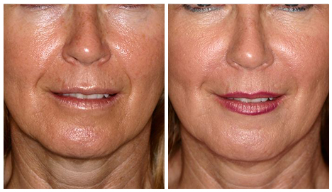 Before After - Fillers - Skin perfect package