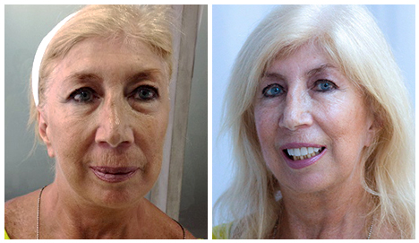 Before After - Naked Skin Package - Micro PRP Dermapen LED