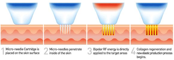 RF-Microneedling