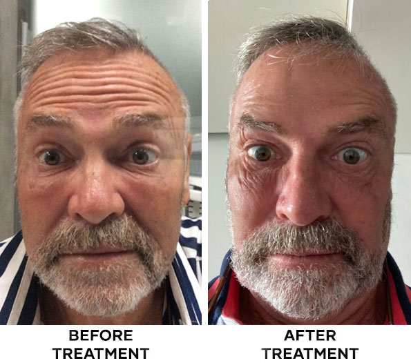 forehead-botox-results-bali-06