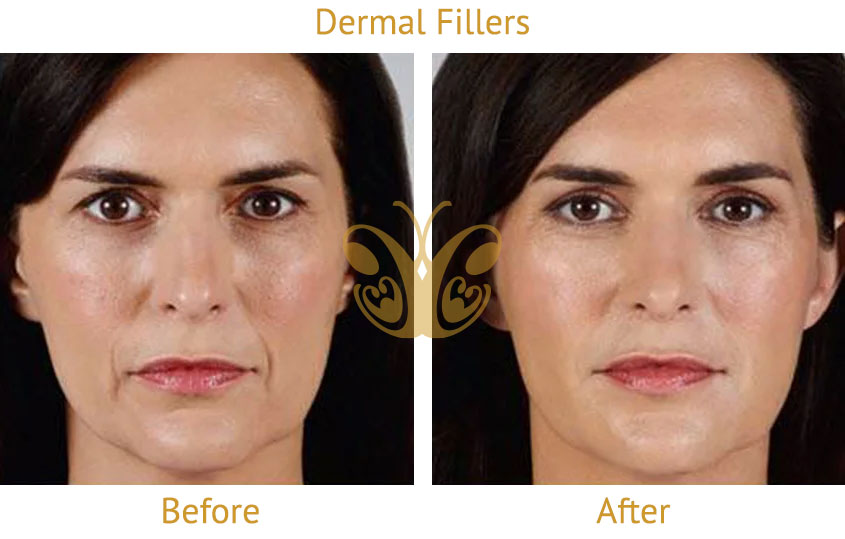 Before and after dermal filler for accordion lines and cheek wrinkles, Cocoon Medical Spa Bali.
