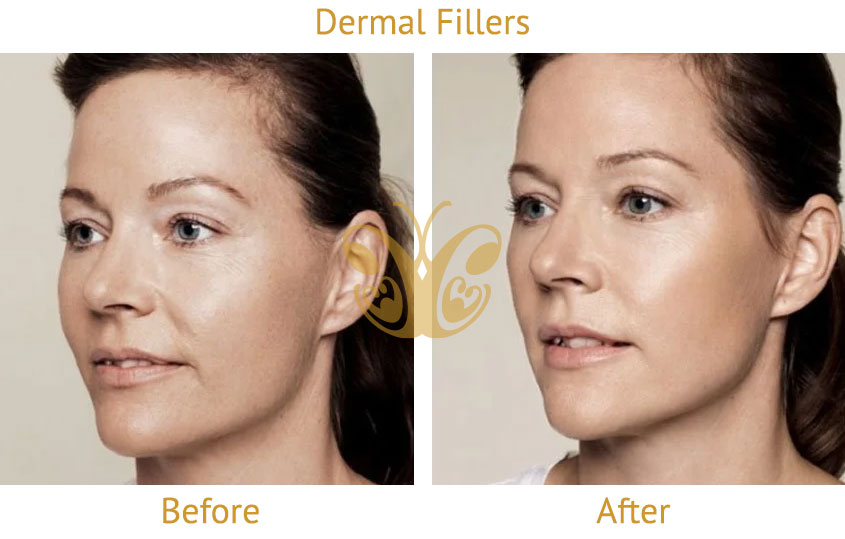 Accordion lines filler treatment before and after results for lower face sagging.