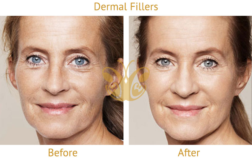 Dermal Fillers under eye before and after results Cocoon Medical Spa Canggu