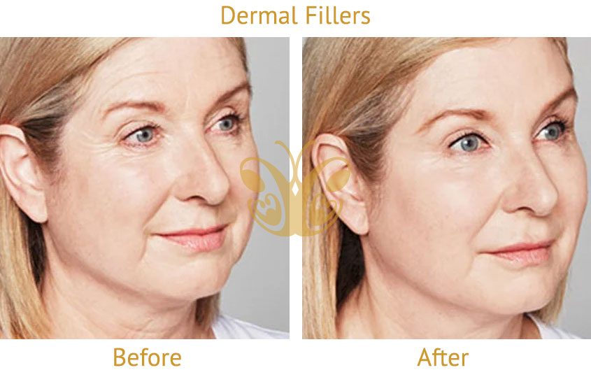 Cheek filler - Midface lift transformation before and after, Legian Bali.