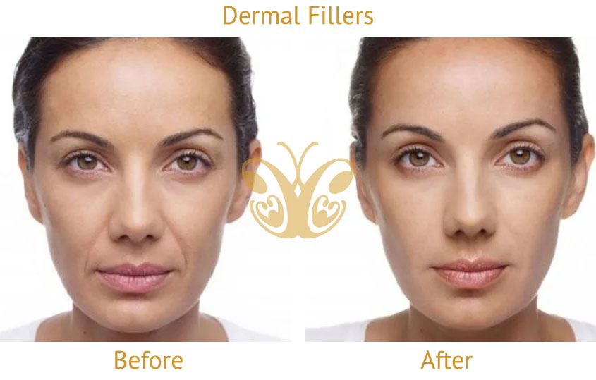 Nasolabial Smile lines filler before after