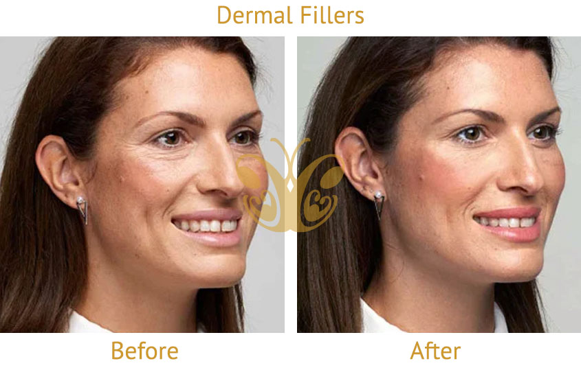 Tear trough - hallow eyes before and after Cocoon Medical Spa Bali