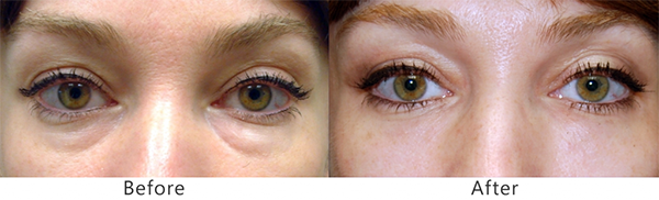 JuvTearTroughs-1024x311