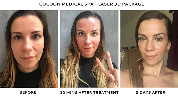 resurfacing skin treatment 3 Resurfacing  Skin Medical Cocoon Spa  Laser