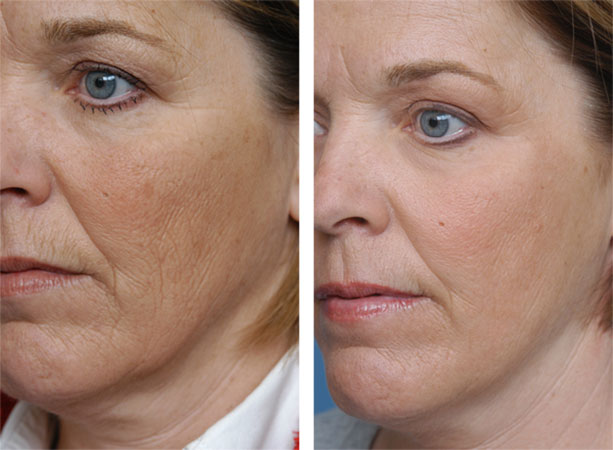 fractional laser before and after