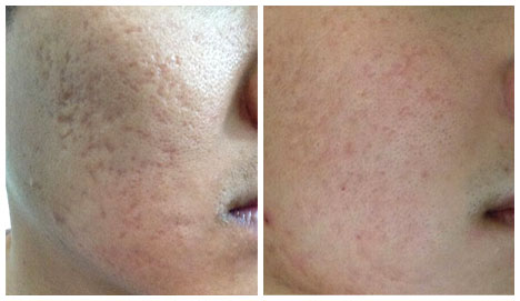 Before – After PRP Treatment