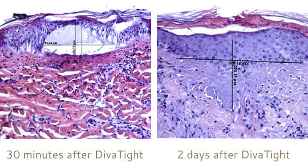 DivaThight result - vagina tightening