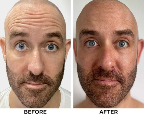 Result of Botox - Cocoon Medical Spa Bali