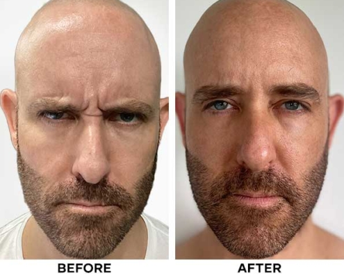 Result of Botox - Cocoon Medical Spa Bali