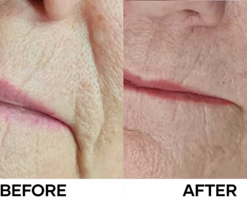 Peptide Skin Booster at Cocoon Medical Spa