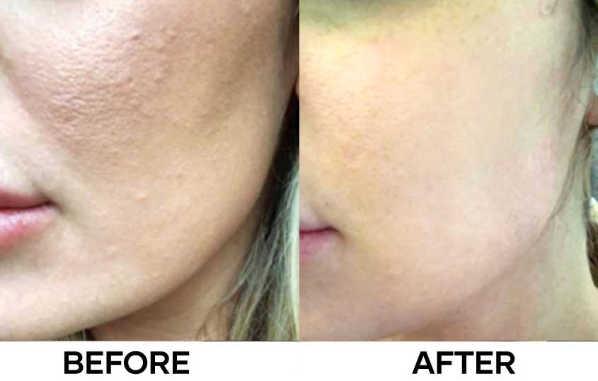 Before After image - NEWEST by Mastelli