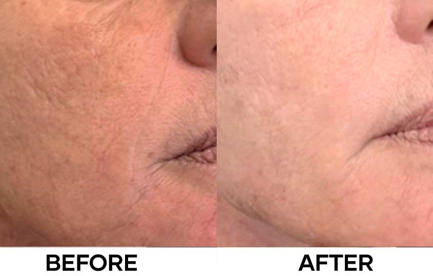 Before After image - NEWEST by Mastelli