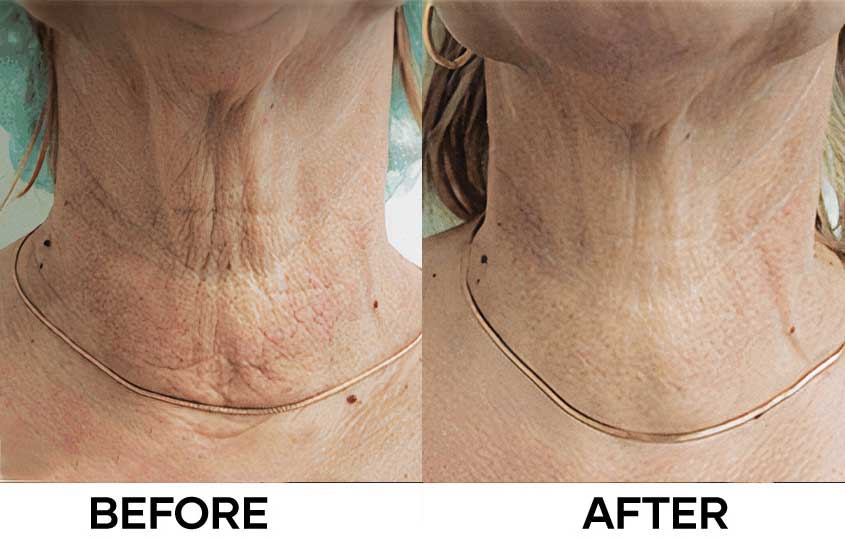Before After image - NEWEST by Mastelli
