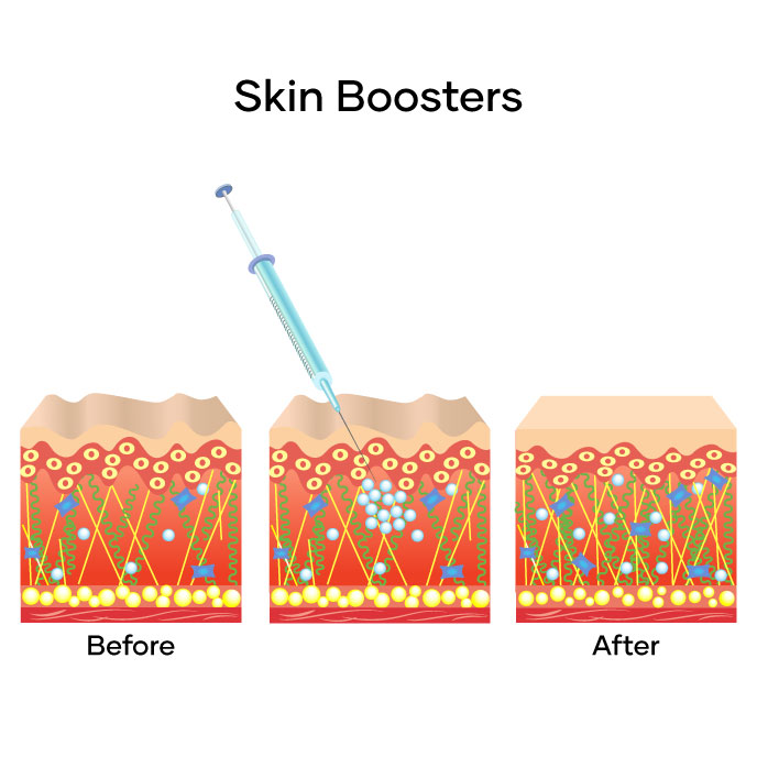 Skin Boosters Diagram